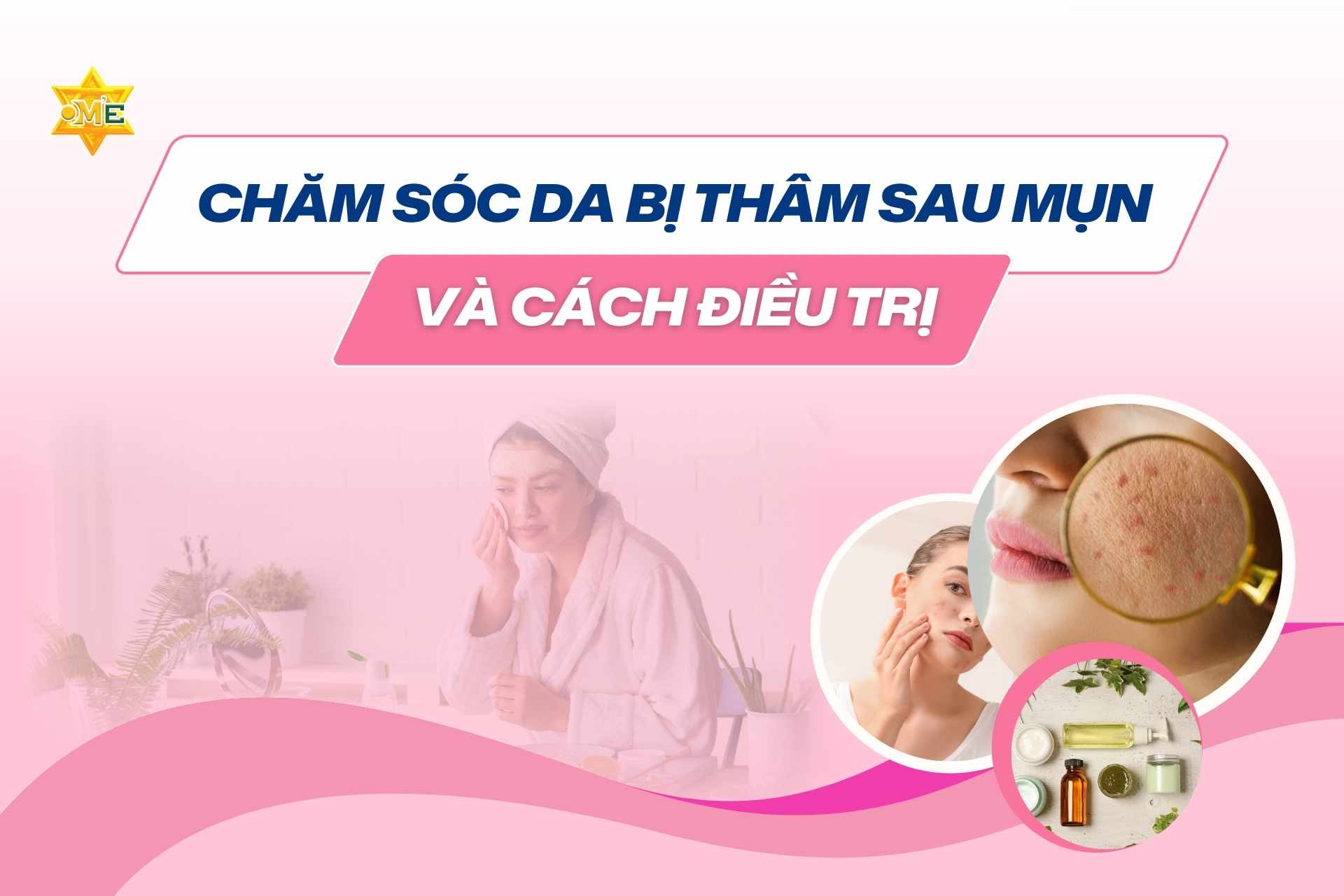 Thâm sau mụn: Nhận biết đúng và điều trị hiệu quả để lấy lại làn da sáng mịn