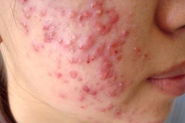 Chăm sóc da mụn tuổi dậy thì – Hiểu đúng để làn da khỏe và tự tin hơn